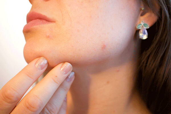 Tea tree oil, witch hazel & milk of magnesia are just a few of the all-natural treatments you can use to make pimples go away and keep problem acne at bay. Credit: Kjerstin Michaela, Pixabay.w